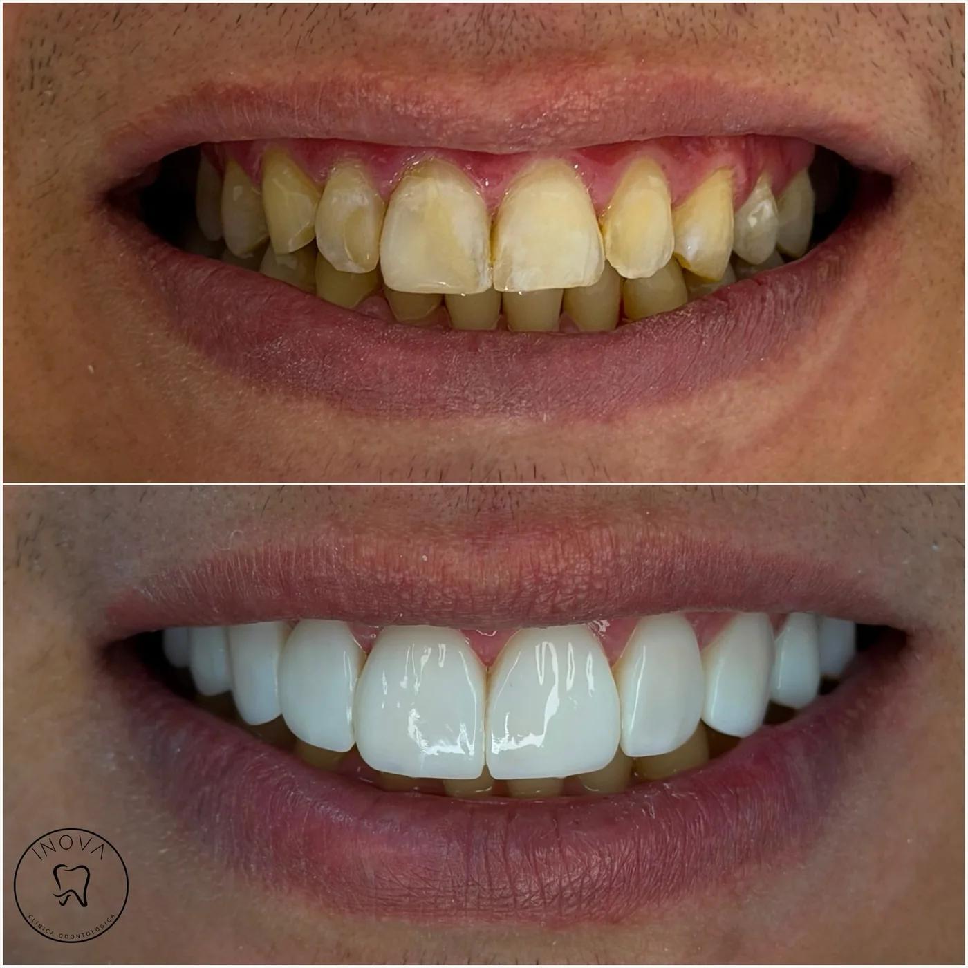 Antes e depois de tratamento odontológico estético na Clínica INOVA