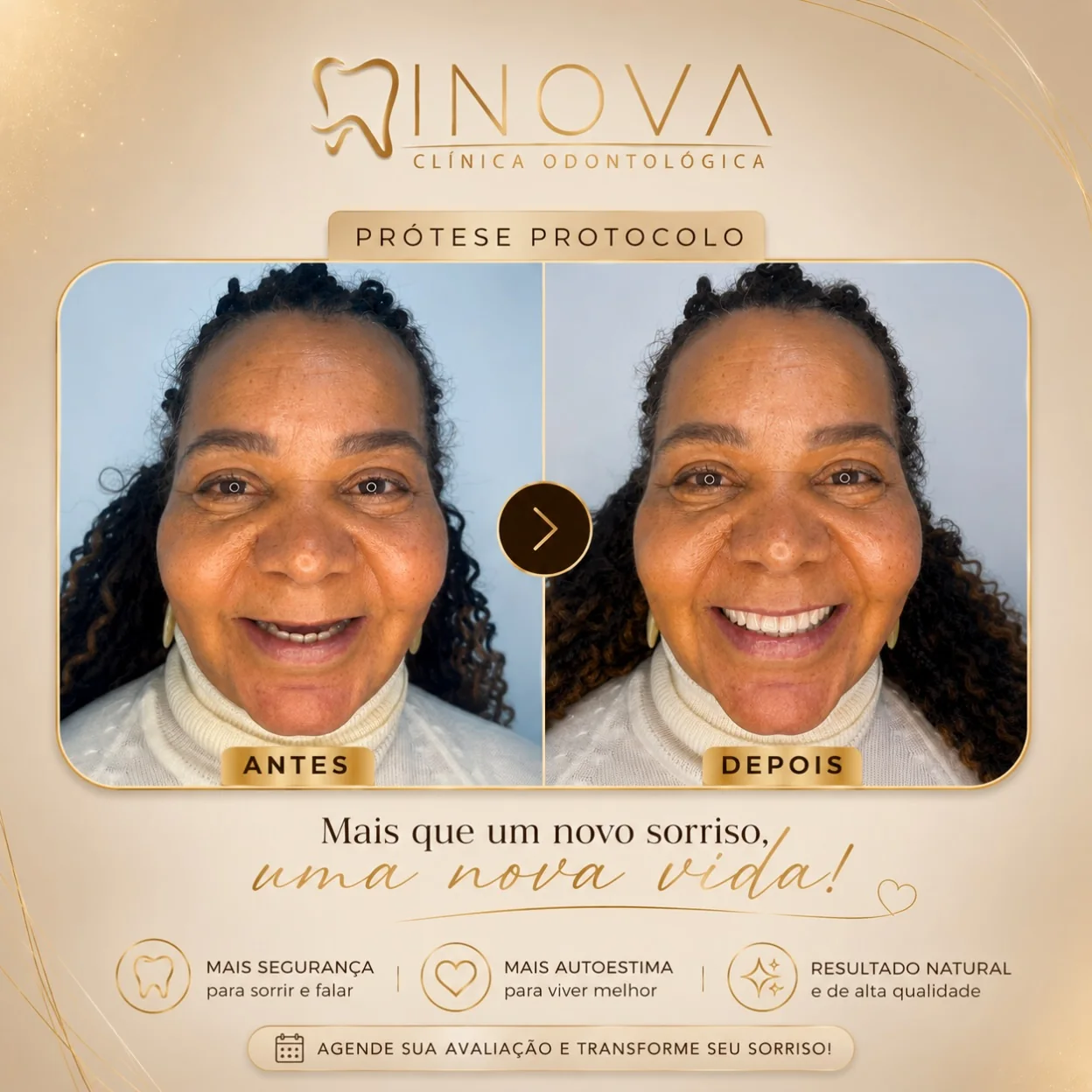 Caso real de prótese protocolo realizado na Clínica INOVA
