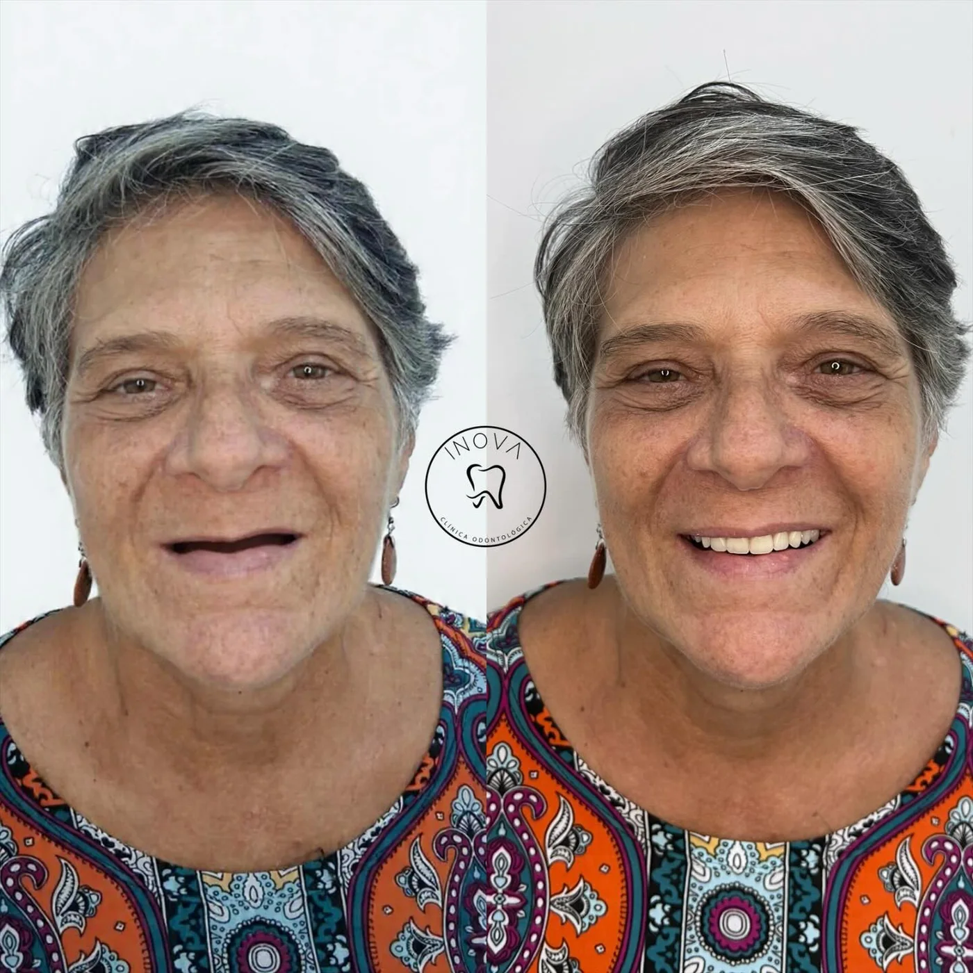 Antes e depois de reabilitação oral na Clínica INOVA