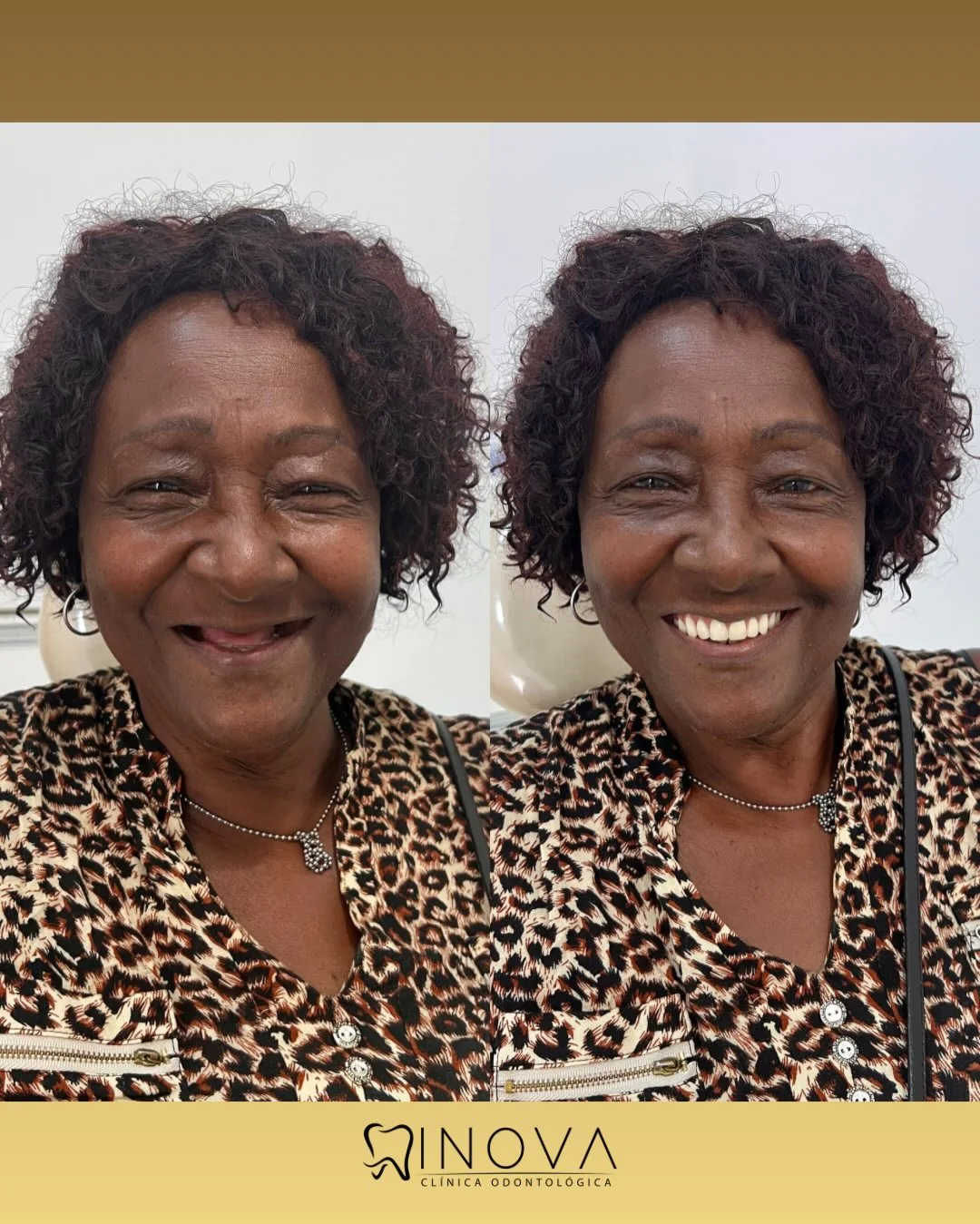 Antes e depois de reabilitação do sorriso na Clínica INOVA